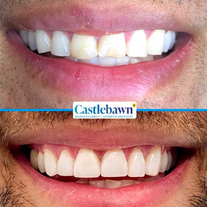 composite bonding in  Bangor and Newtownards