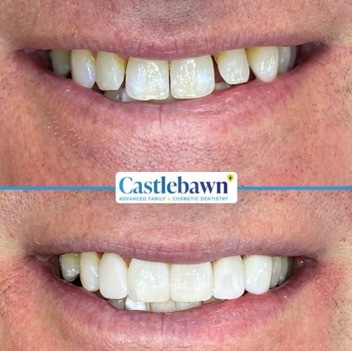 composite bonding in  Bangor and Newtownards